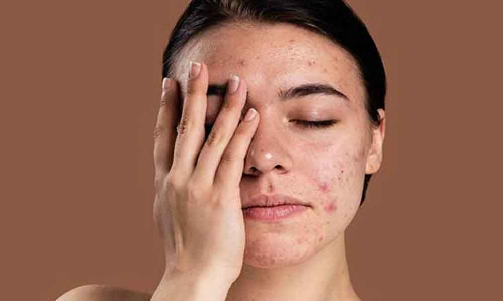 Treating Pimple Marks
