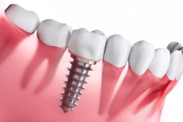How Dental Implants