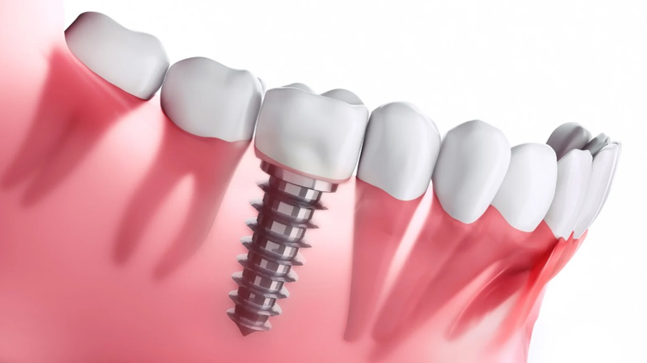 How Dental Implants
