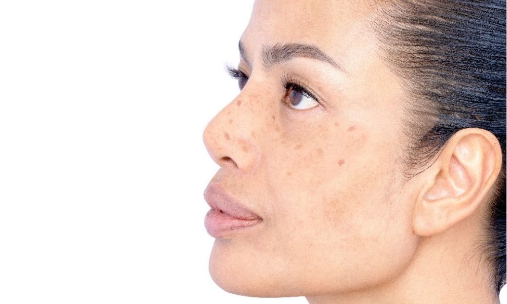Pico laser treatment downtime