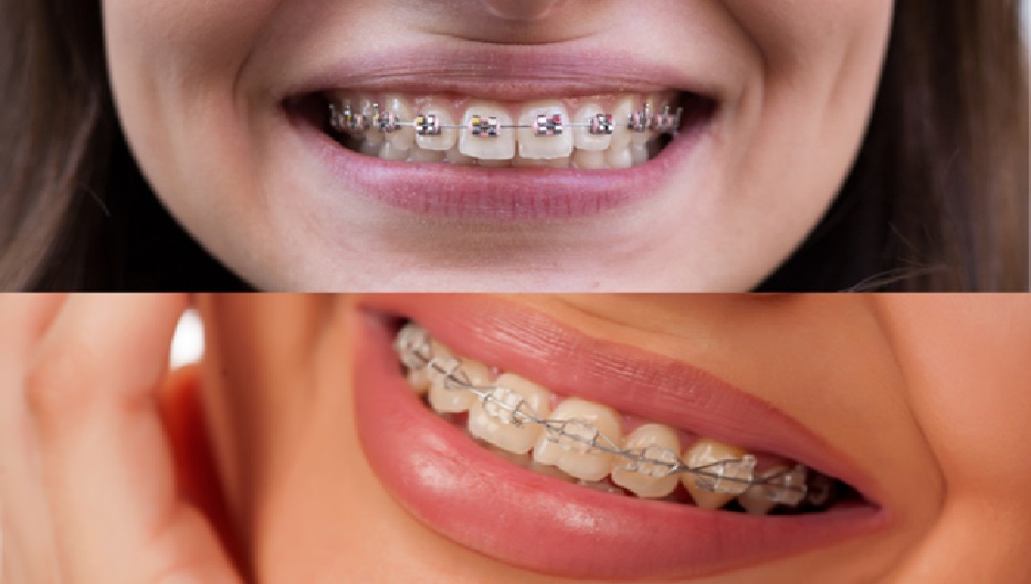 DIY Braces